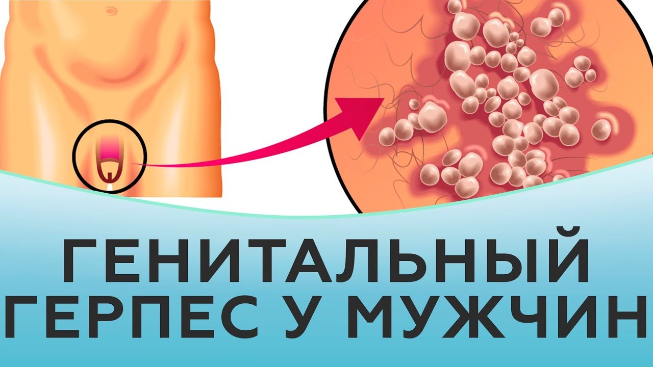 Герпес. Генитальный герпес у мужчин.