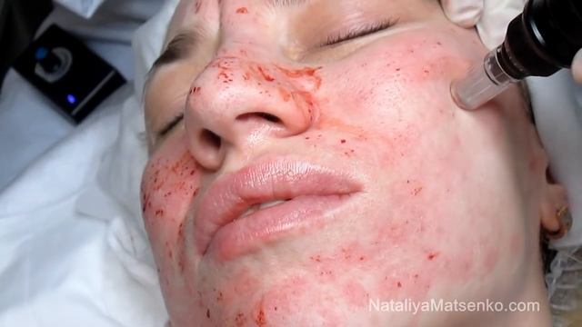 Дермапен Dermapen Часть 2