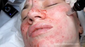Дермапен (Dermapen) Часть 2