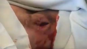 Гидраденит hydradenitis