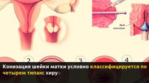 Конизация шейки матки