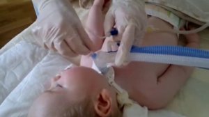 Санация трахеостомы и полости рта