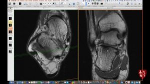 Systematic Interpretation of Ankle MRI: How I do it