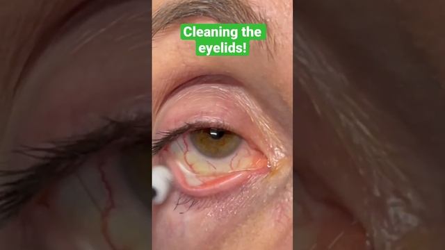 Cleaning the eyelids! #dryeye #biofilm #eyes #cleaning смотреть онлайн