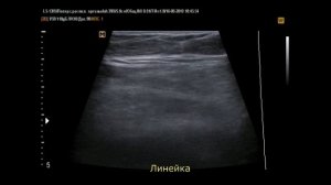 УЗИ при остром аппендиците, сравнение датчиков