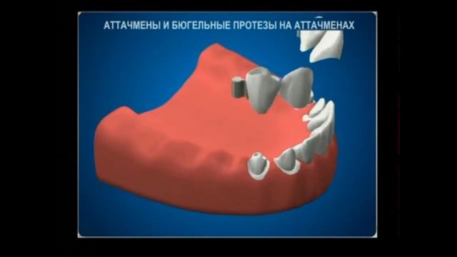 Бюгельный протез на замках
