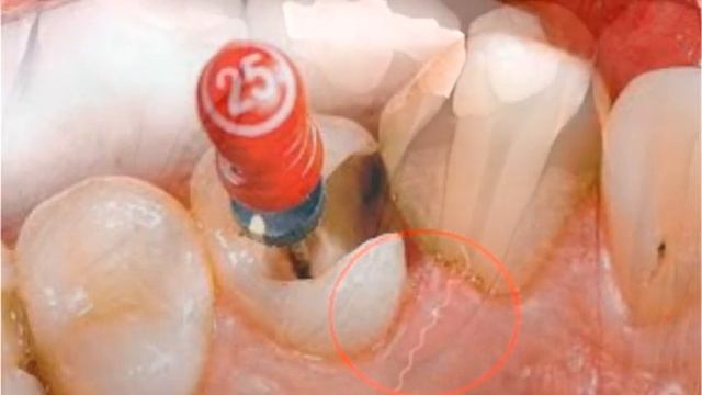 Что натворил стоматолог??? // Болит зуб после лечения!! смотреть онлайн