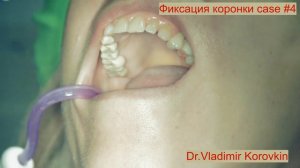 Фиксация коронки из оксида циркония(Pretau ).Кейс #4.
