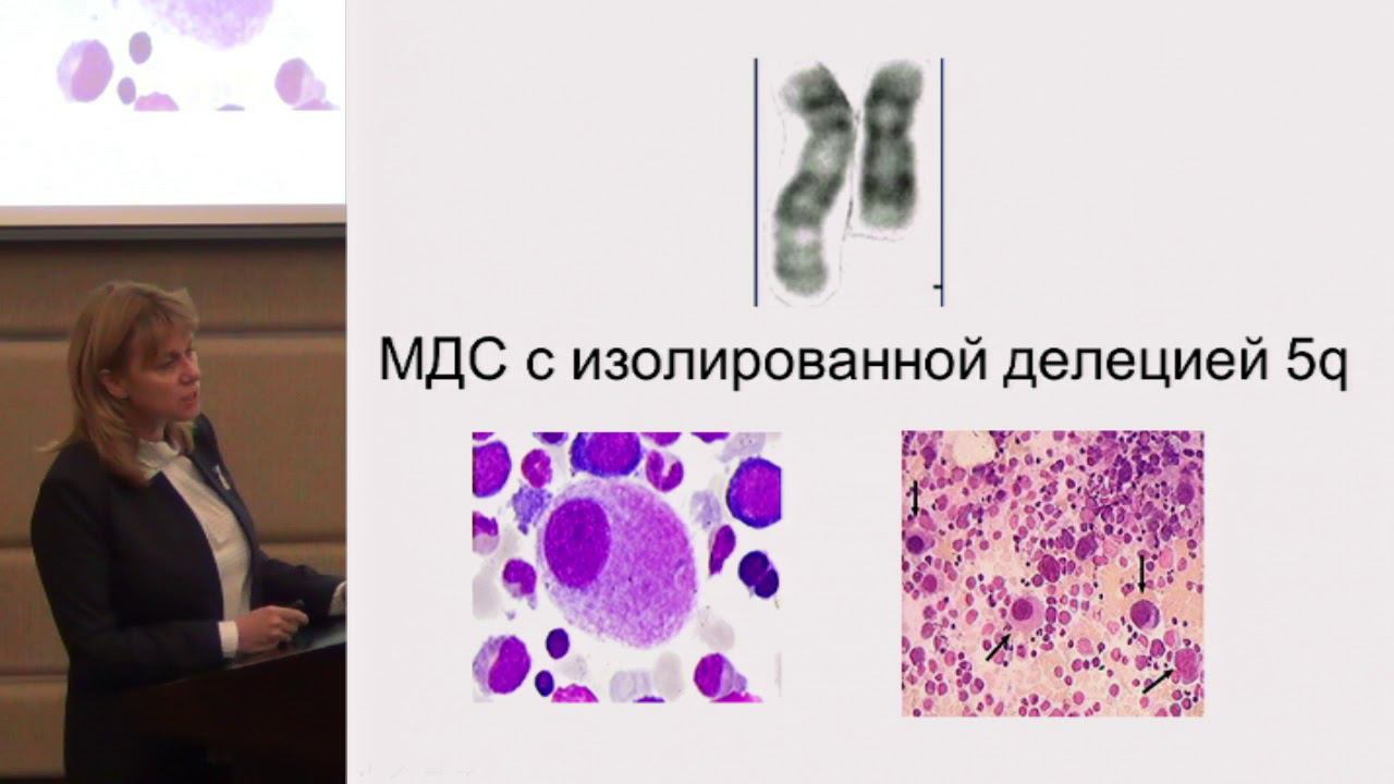 Кохно А.В., Современные подходы к диагностике и лечению миелодиспластического синдрома.