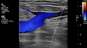 СФС, проба Вальсальвы