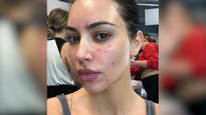 НЕ ДЛЯ СЛАБОНЕРВНЫХ: КИМ КАРДАШЬЯН ПОКАЗАЛА ПОРАЖЕННОЕ ПСОРИАЗОМ ЛИЦО