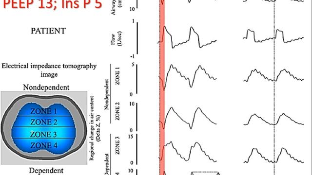 Самоповреждение легких при ИВЛ Горячев А.С. смотреть онлайн