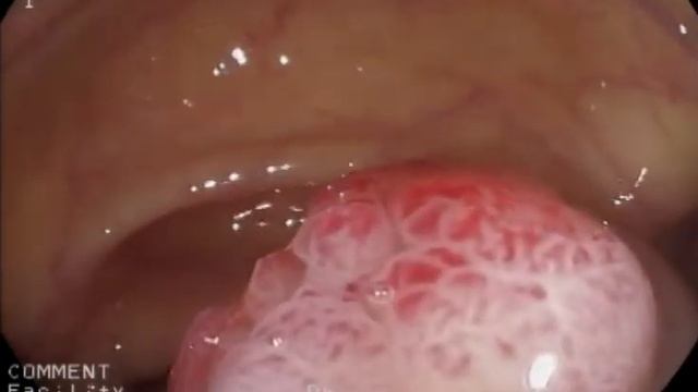 Удаление полипа толстой кишки с наложением эндоскопической клипсы.