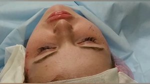 АирисКом студенты учатся: филлеры для создания скул. До и после. 2 мл филлер. Увеличение скул.