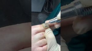 Онихомикоз ногтей