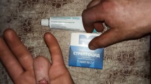 Оторвало ноготь на пальце