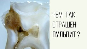 Пульпит - это самое частое осложнение от кариеса‼️