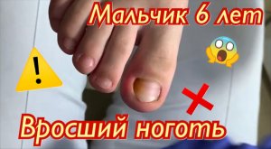 Мальчик 6 лет⚠️?❗️ • Вросший ноготь????