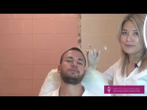 Коррекция морщин у мужчин