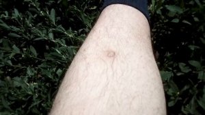 После укуса клеща. Спустя 50 дней