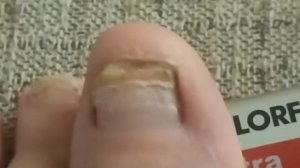 Отбитый ноготь часть 10. Как отрастает ноготь оторванный. Ноготь уже почти вырос