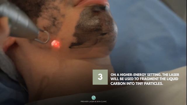 EVERYTHING YOU NEED TO KNOW ABOUT CARBON SPECTRA PEEL (HOLLYWOOD PEEL) смотреть онлайн