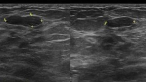 ЛЕКЦИЯ  6. BI-RADS - ПРОСТО О СЛОЖНОМ.