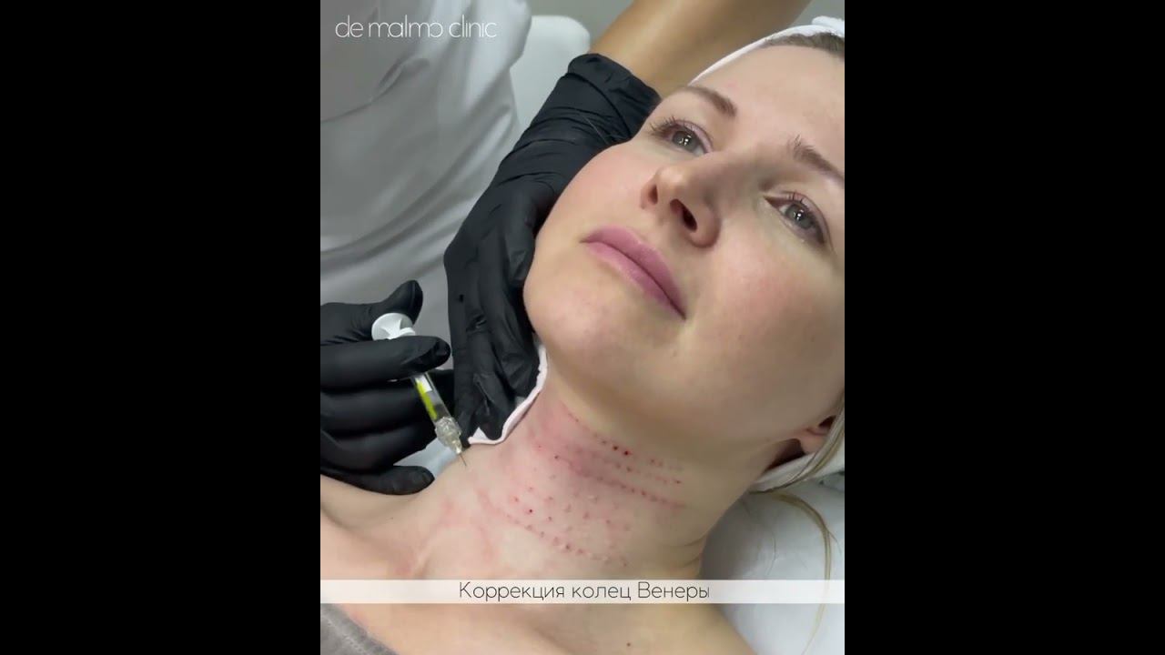 Контурная пластика шеи