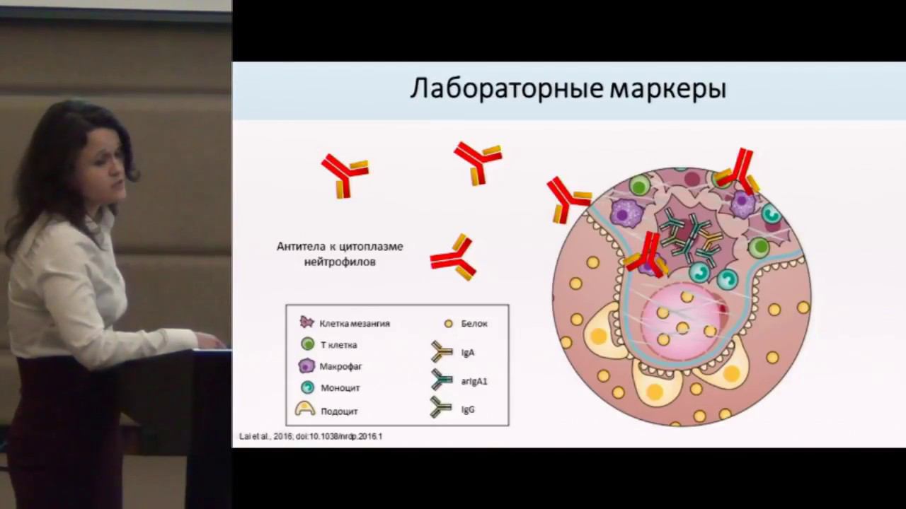 Зыкова А.С. IgA-нефропатия с клиническим фенотипом микроскопического полиангиита