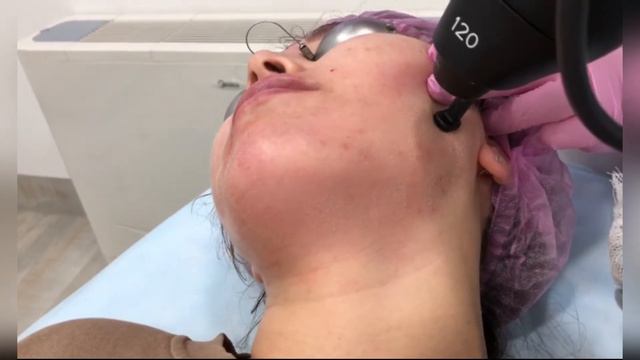 Лазерная шлифовка кожи смотреть онлайн