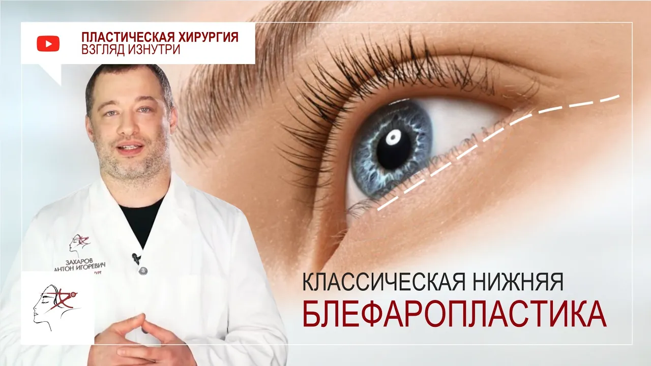 Нижняя блефаропластика