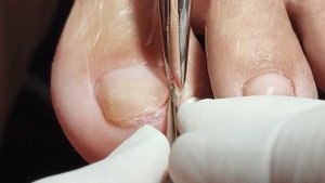 PODOLOGIA EM UNHA ENCRAVADA (OVERGROWN INFECTED INGROWN TOENAIL REMOVAL)