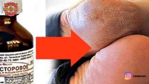 Натоптыши, сухие мозоли, трещины на пятках не дают покоя?4 СУПЕР СПОСОБА гарантированно помогут!