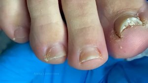 ПОЧЕМУ КЛИЕНТ НЕ ВЕРНУЛСЯ? ГРИБОК НОГТЕЙ /ОТКУДА ГРИБОК? СКРУЧЕННЫЙ НОГОТЬ / ОНИХОЛИЗИС / ОНИХОМИКО