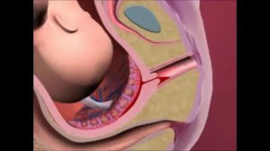 Предлежание плаценты