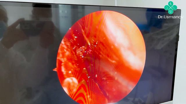 Burun to’sig’ini qiyshiqligi va surunkali gaymorit | Dr Bahodir Usmanov смотреть онлайн