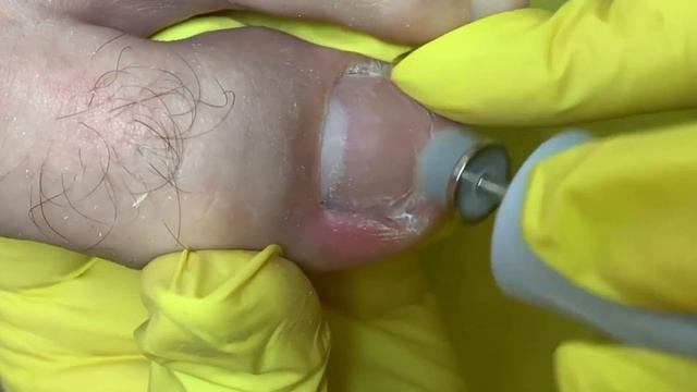 Ногти оторваны??⚠️ • Околоногтевой мозоль❗️??? смотреть онлайн