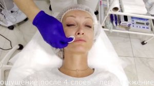 пилинг Джесснера