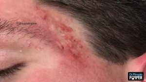 Acne Vulgaris and Extracting large Whiteheads - Part 1