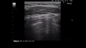 Липома мягких тканей лопаточной области на УЗИ