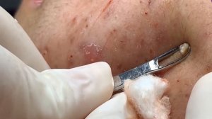 Best Pimple Popping Videos / Satisfying video #2