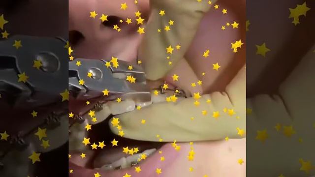 Снятие брекетов — как происходит и что после