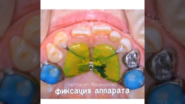 Как делают несъёмные детские пластинки