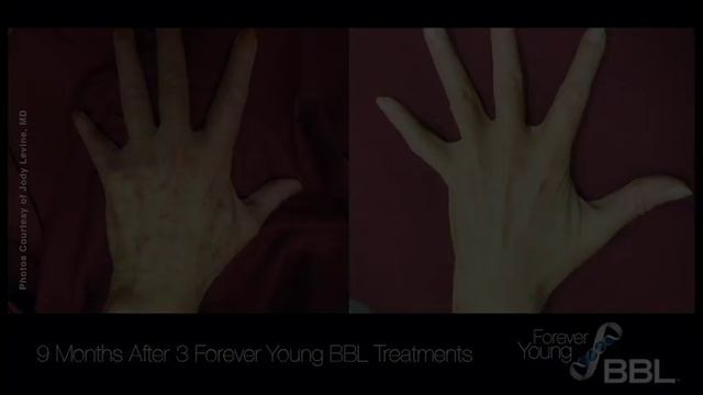 Forever Young BBL - Look Younger With Laser Skin Rejuvenation From South Coast MedSpa