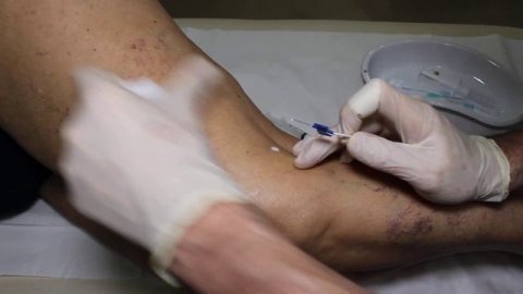 склеротерапия