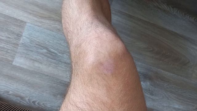 Шишка на Коленке, причина и профилактика смотреть онлайн