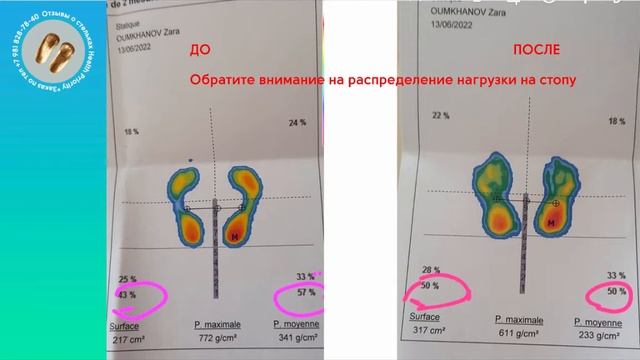 Отзыв о стельках Health Priority. Зара. Франция о стельках Приоритет Здоровье