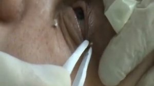 Удаление бородавок на лице