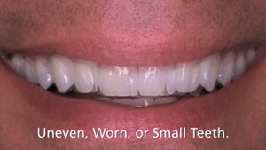 Безметалловая керамика E-MAX (Е МАКС), IPS e max, виниры