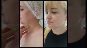 липоредукция